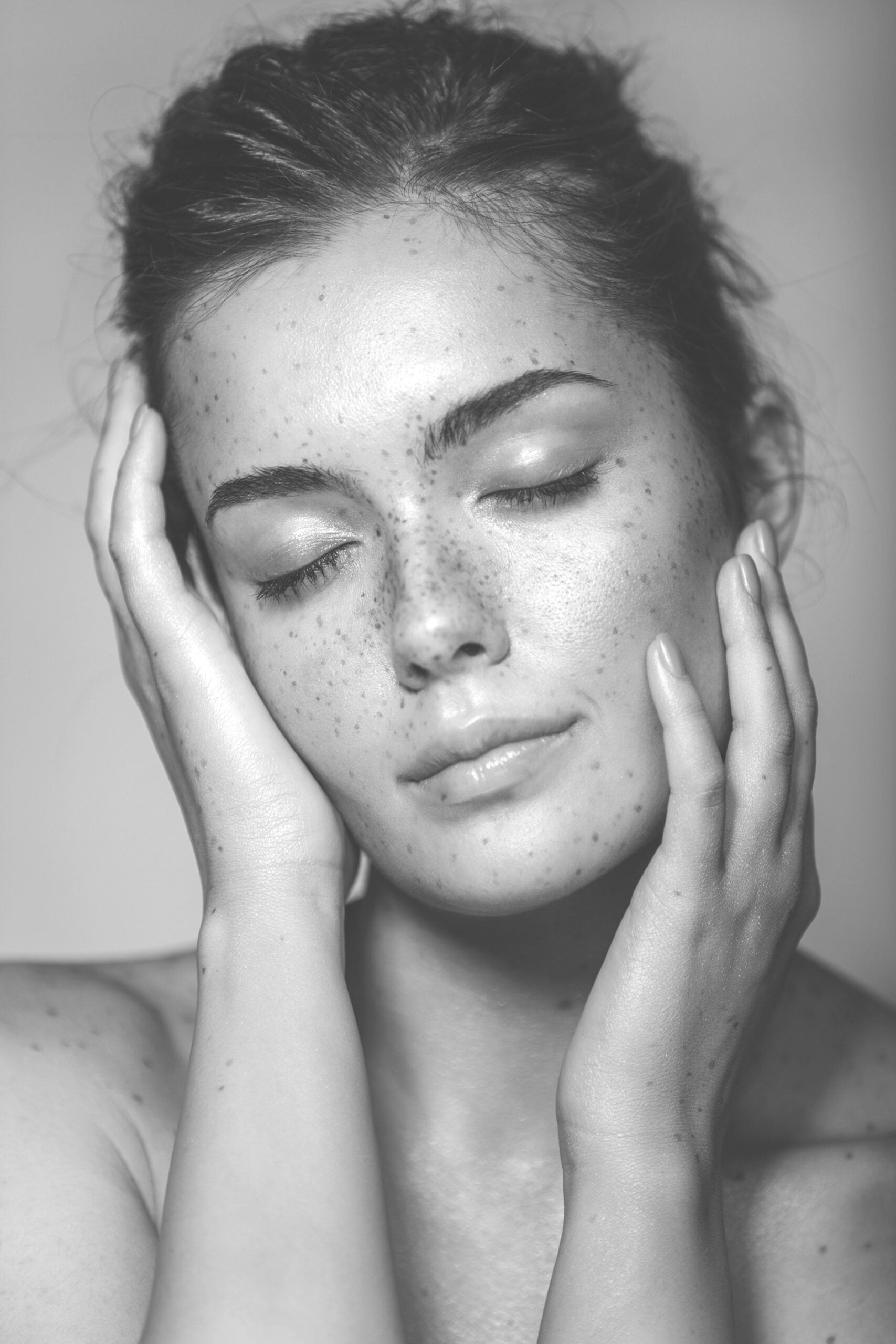 Active Acne Laser Treatment in Bristol & Brighton